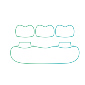 Implant Crown & Bridges
