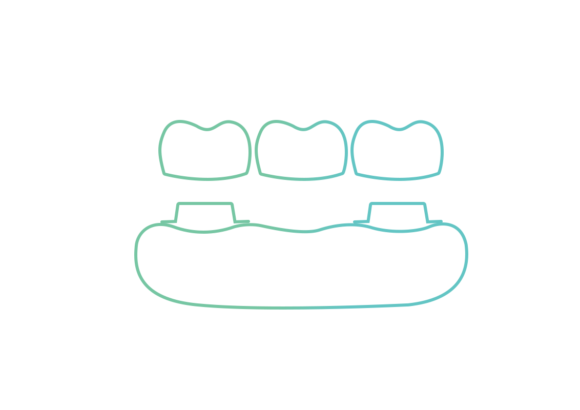 15. Implant Crown and Bridges Implant Crown & Bridges