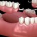 Design of Removable Partial Dentures